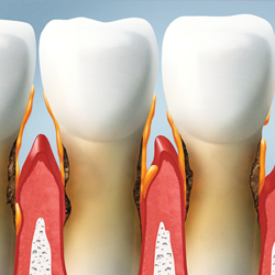 Periodontal Disease