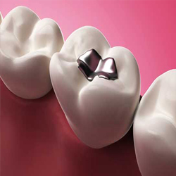 Dental Restorations